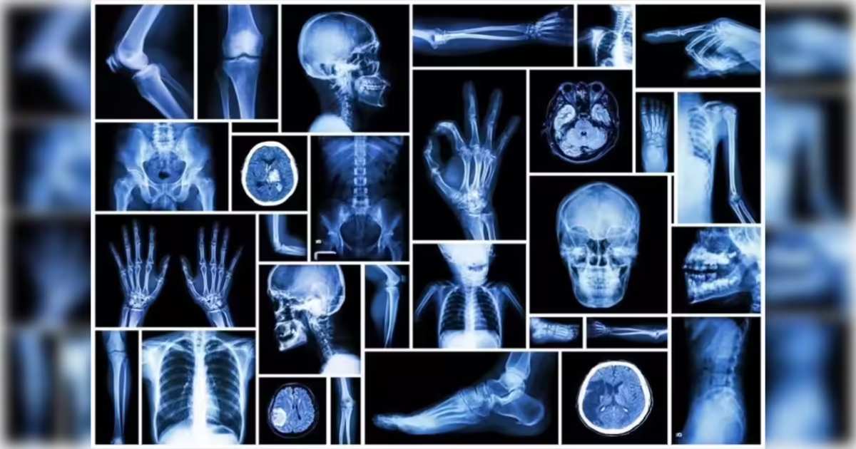 X-Ray
